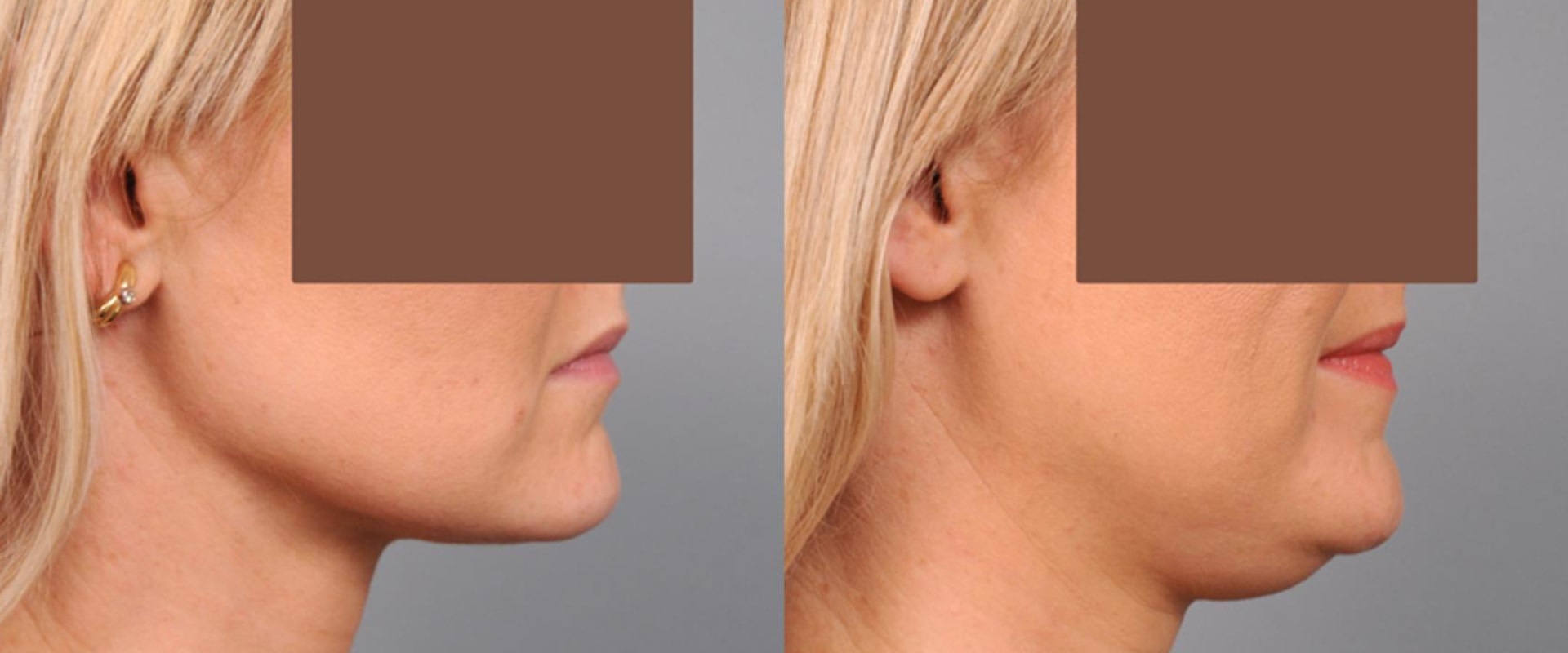 NYC Chin Liposuction: How It Differs From Laser Liposuction For Fat Removal