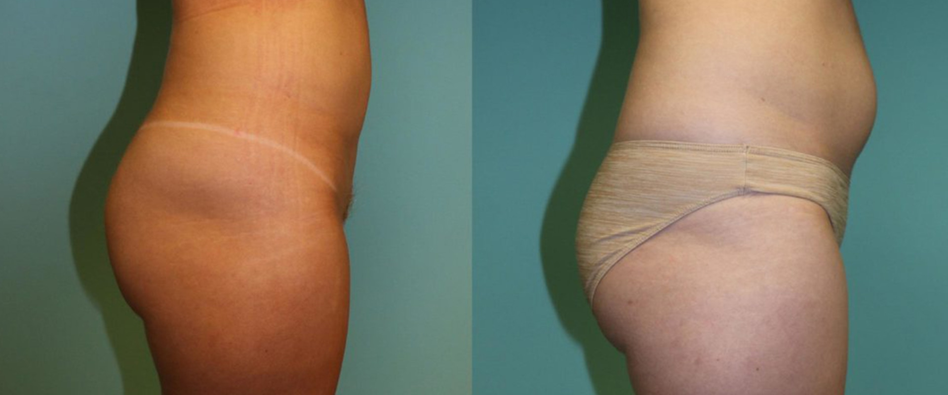 The Benefits Of Visiting A Plastic Surgery Clinic In Chevy Chase For Laser Liposuction Procedures