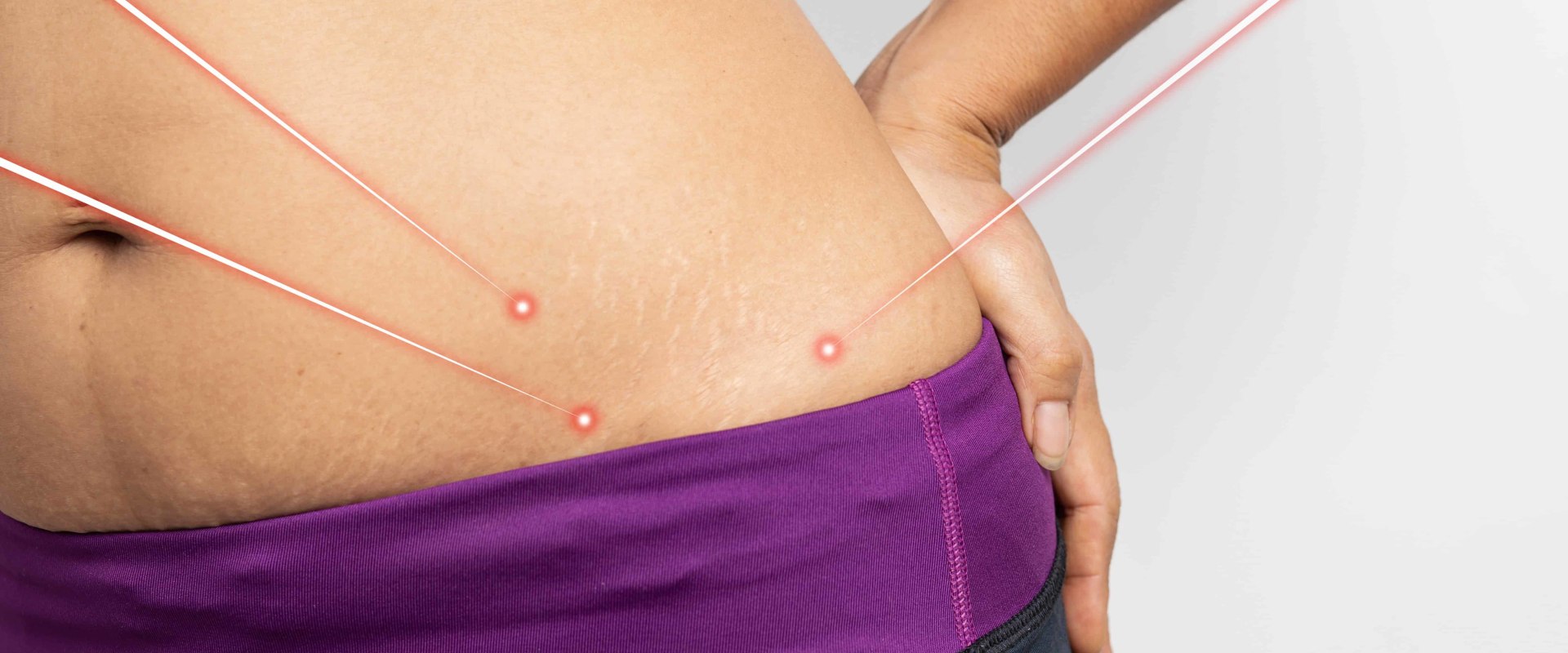 Does laser lipo get rid of belly fat?