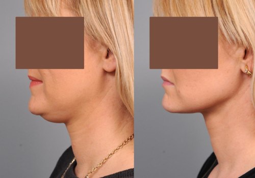 NYC Chin Liposuction: How It Differs From Laser Liposuction For Fat Removal