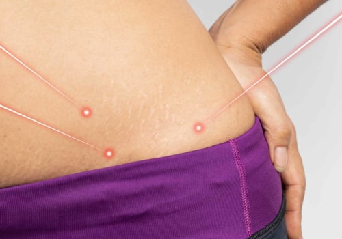 Can laser lipo cause weight gain?