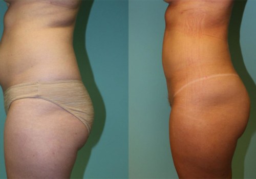 The Benefits Of Visiting A Plastic Surgery Clinic In Chevy Chase For Laser Liposuction Procedures